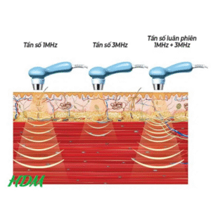 Liệu pháp siêu âm